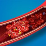 Blood Clot Symptoms