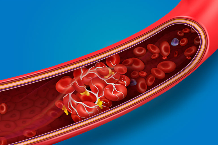 Blood Clot Symptoms